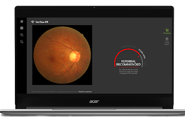Acer to expand Diabetic Retinopathy Screening by launching AI-assisted Diagnostic Solution to local hospitals and clinics